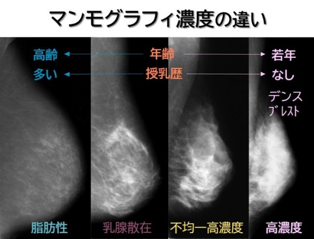 マンモグラフィ濃度の違い