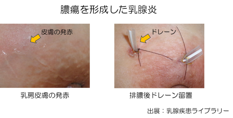 腫瘍を形成した乳腺炎の写真